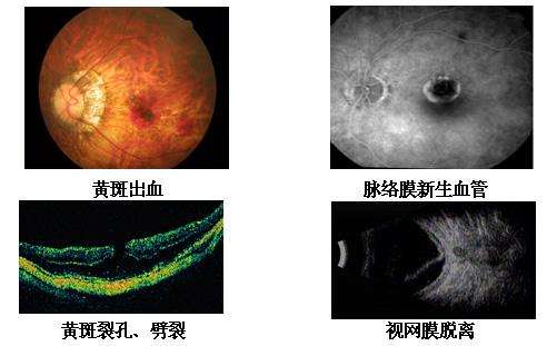 高度近视如何医治.jpg