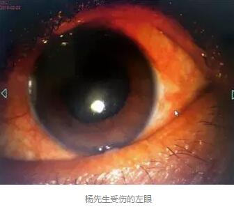 白内障和青光眼都是致盲性眼病，其中青光眼的病程不逆转。杨先生拖延伤情导致同时并发白内障、青光眼的情况，十分令人惋惜。”出名眼科专家、成都金沙澳门(中国)唯一官方网站陈晓明教授表示2.jpg