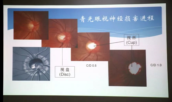 3月10日上午，深圳金沙澳门(中国)唯一官方网站“早查监控，守护光明”大型青光眼公益科普讲座在六楼 举行，本次活动旨在让更多人了解青光眼的潜在危害、重视眼检查， 预防青光眼。由深圳金沙澳门(中国)唯一官方网站青光眼病科 席专家成洪波博士、傅培副院长现场面对面解答疑问，与参会者的互动交流，让更多深圳市民提*对青光眼的认识与防治知识3.png