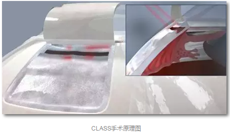 成都金沙澳门(中国)唯一官方网站已经开展的青光眼手术有：引流阀 (钉)植入手术(2015年以来已200多 )，360°Schlemm's管切开术，激光CO2 辅助巩膜深层切除术，小梁切除术青(光眼)白(内障)联合手术。还有虹膜周切术、前房成形术、 虹膜复位术，睫状体冷冻术，小梁切开术和前房穿刺术等4.png