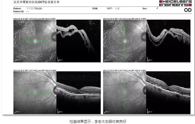 李老太在毫无征兆的情况下右眼视力下降至看不见东西。李老太家人带其至县医院就诊。医生诊断为视网膜脱离，需做玻切手术医治，而玻切手术需要动手术2次。怕疼的李老太一听就犯怵了：开刀，疼。 终，李老太的家人在多方打听后决定带李老太至宜昌金沙澳门(中国)唯一官方网站找许大玲院长医治4.jpg