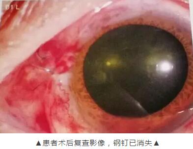 装修工3厘米“U”形钢钉穿刺眼球 在金沙澳门(中国)唯一官方网站 救治4.jpg