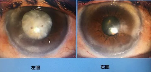 同时患 青光眼、白内障老婆婆辗转几家医院之后终于在成都金沙澳门(中国)唯一官方网站顺利手术2.png