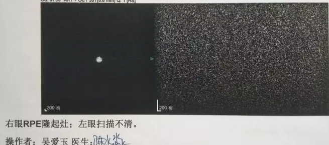 患者突然失明在厦门眼科中心就诊 原是突发玻璃体出血2.png 患者突然失明在厦门眼科中心就诊 原是突发玻璃体出血2.png