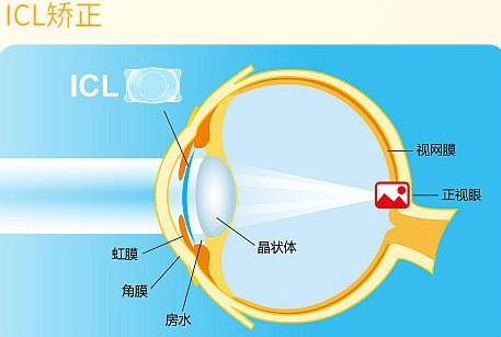 近视无法根治？但你可以这样做？金沙澳门(中国)唯一官方网站“有爱就有希望”近视手术火热进行中8.png
